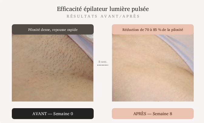 avant / après épilation lumière pulsée